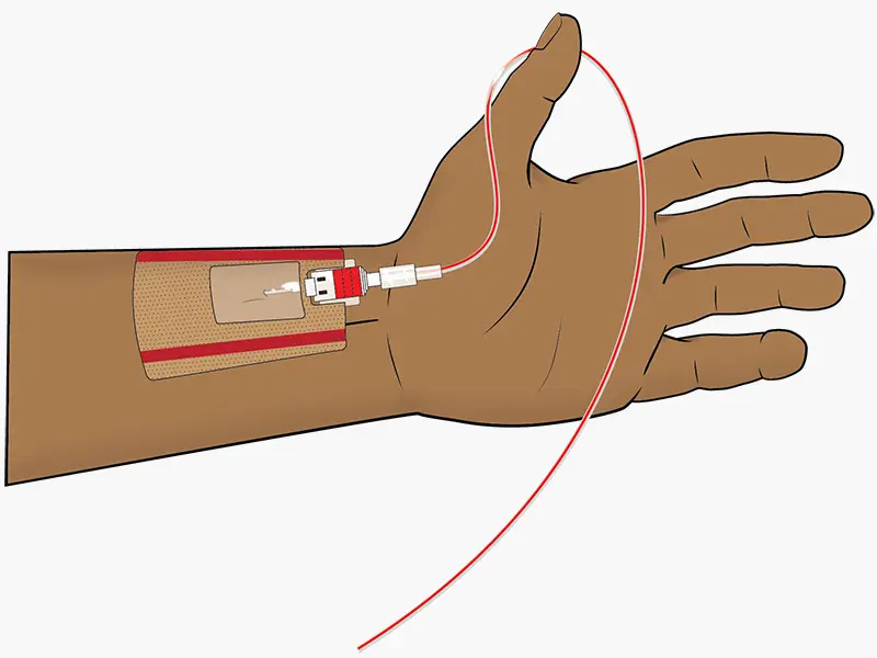 arterial catheter insertion